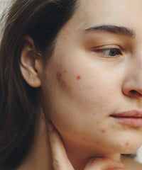FOUR INGREDIENTS PROVEN TO HELP CLEAR ACNE-PRONE SKIN
